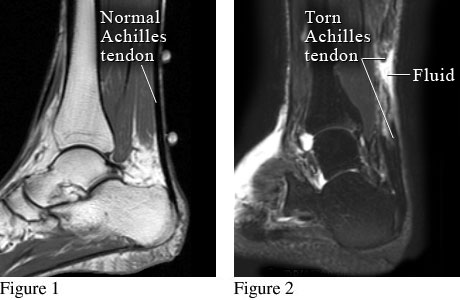 Cipro tendon rupture frequency Cipro tendon rupture frequency